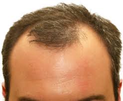 Frontal hair loss treatment - hairline lowering